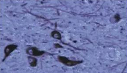 正常人:黑质神经元存在