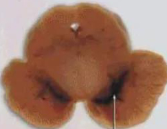 正常人:正常黑质