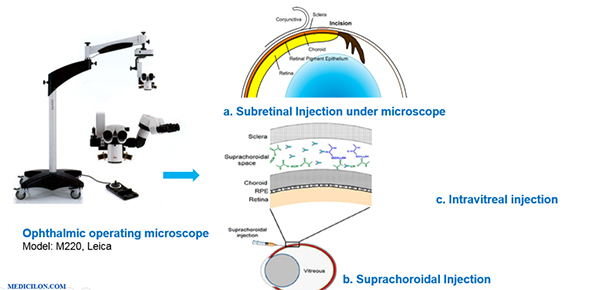 特殊的眼部球内给药技术.jpg 特殊的眼部球内给药技术.jpg